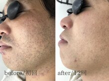 脱毛専門サロン エリクサー(Elixir)/肌荒れも改善