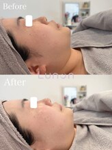 ルノン(Lunon)/毛穴洗浄ハイドロ