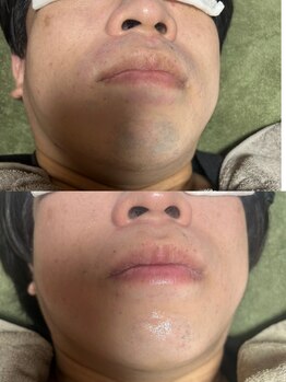 スリール(sourire)/ビフォーアフター