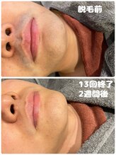 ワイズサロン(Y's salon)/ヒゲ脱毛13回終了