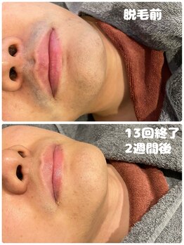 ワイズサロン(Y's salon)/ヒゲ脱毛13回終了