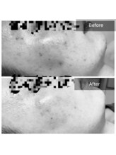 エミルカ(EMILUCA)/ハーブピーリングでお悩み改善