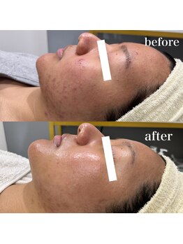 ジョアアンジェ 京橋店(joie ange)/ニキビケア