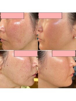 シシラ(shishira)/【Dr.Purで魅せる肌へ】