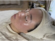 ミーミドットアイ(Mi-mi.i)/after★もみあげフェイスライン