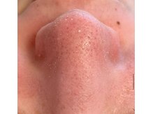 ルチル(Rutile)/韓国式3D毛穴洗浄