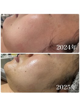 エステサロンブランシュ(Esthe salon Blanche)/ハーブ＋ハイパーナイフ