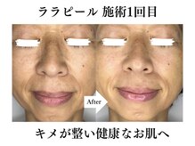 ブレリアントサロン 池袋店(brillant salon)/【50代】ララピール(施術1回目)