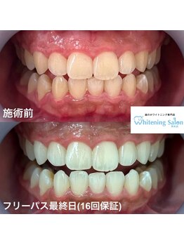ホワイトニングサロン 熊本店/学生さんもホワイトニング