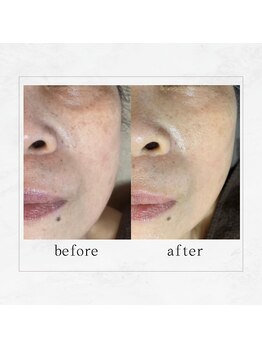 サロンドビューティー 美ふぅ(salon de beauty 美ふぅ)/目のくま&くすみ