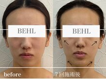 ベール(BEHL)/コルギのBefore After