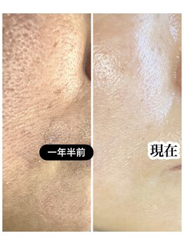 スティーン(Styin)/肌質も変化！【京丹後】