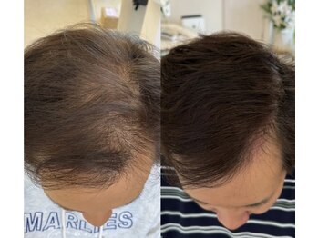 カナエル ビューティーサロン(Canael Beauty salon)/プロセルセラピーズ 4回