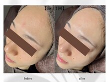 アン ビューティー(ann beauty)/施術1回【症例写真】20代