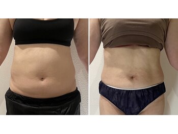 トータルエステティック ジョワイユ(JOYEUX)/★脂肪分解/脂肪撃退★ボディ