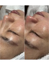 スパークル/毛穴洗浄/脱毛/フェイシャル