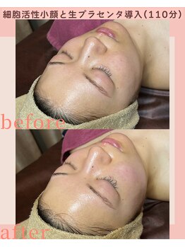 シストワ(sistoi)/小顔に引き締めリフトUP↑↑