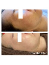 ヴィヴ コレビ(VIV COREBI)/角質くすみ、毛穴の開き撲滅