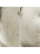 アロンドール リム(alondor rem)/before/afte @BBL光フェイシャル