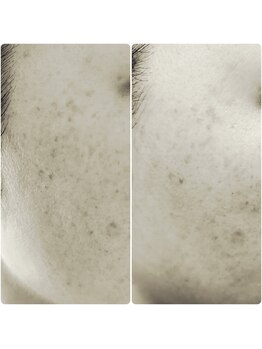 アロンドール リム(alondor rem)/before/afte @BBL光フェイシャル