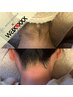 【Wax ×光脱毛】8/30まで限定★うなじ　Wax × 光脱毛　通常5500→