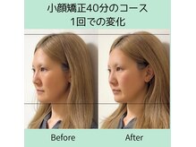 顔の歪みや左右差を整えてスッキリとした小顔に♪