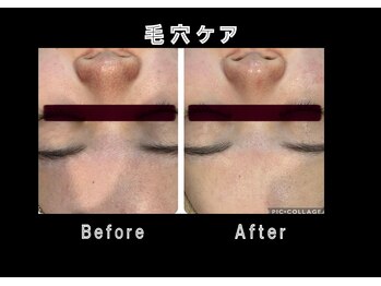 エステティック レイビス 銀座店(RAYVIS)/顔脱毛×ホワイトスノーピール