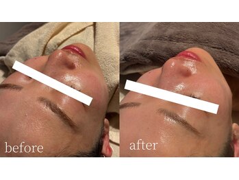 コモレビ(komorebi)/町田駅/フェイスワックス/顔脱毛