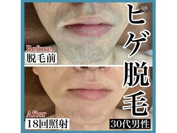 ツバキ(TSUBAKI)/ヒゲ脱毛