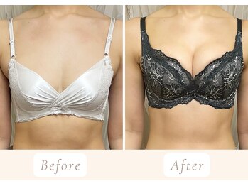 ノルン(Norn)/20代育乳バストケア(3回目)