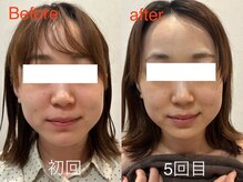 ビーキュート 学芸大学店(BE-CUTE)/Before/After　施術