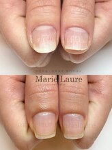 マリーロール 梅田店(Marie Laure)/深爪矯正/自爪育成/自爪風