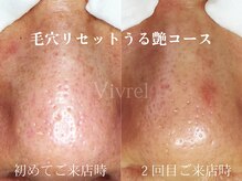 ヴィヴレル(Vivrel)/【毛穴エクストラクションプロ】