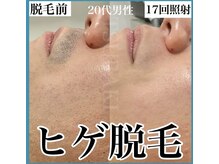 ツバキ(TSUBAKI)/ヒゲ脱毛