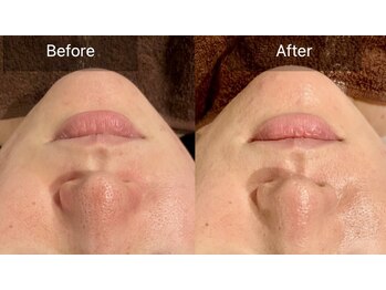 エミルカ(EMILUCA)/ハーブピーリングでお悩み改善