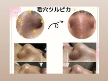 アモロッソ(amorosso)/鼻の毛穴洗浄【同時施術】