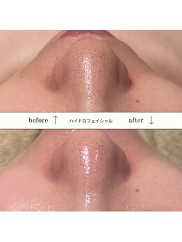 レア(le'a)/ハイドロフェイシャル