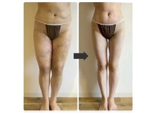 スリーピングビューティー(Sleeping Beauty)/インディバ　術後ケア