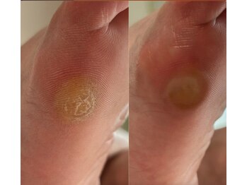 アベビー(Abeby)/靴も併せて見直しがオススメ