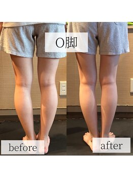 ミーツ(MEETS)/O脚のお悩み/2回