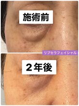 プリュネル(Prunelle)/プラズマシャワー