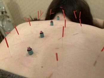 ヨウスタイル(YOU STYLE)の写真/慢性的な首肩コリならお任せください！痛みの少ない鍼灸でその場しのぎではなく根本改善へ導きます◎