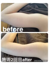 ギンザアール(GINZA R.)/二の腕に徹底アプローチ！