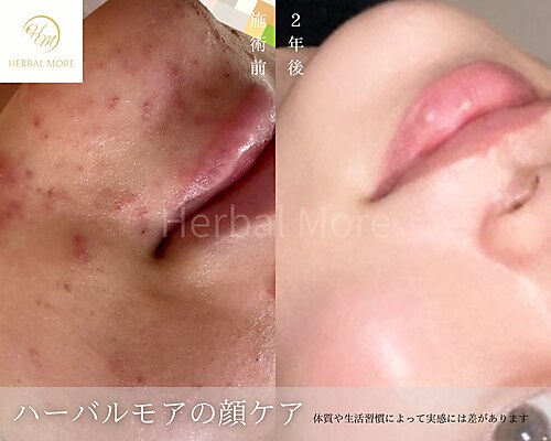 20ページ目｜ハーブピーリング 剥離ありに関するエステサロン 毛穴