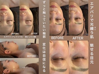アンミー(anmiiy)の写真/別府市初導入！エアバリで叶う、内側から整える艶肌☆首から変える大人の肌悩み◆たるみ/二重あご/小顔◆