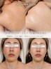 【大切な日のために】背中ハーブピーリング×眠れる小顔コルギ（130分）