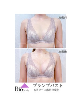 バイオビューティー 神戸本店(Bio Beauty)/プランプバスト　6回コース症例