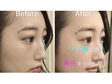 ラプリアンジュ 鹿児島天文館店(Raplit ange)/隆鼻＋輪郭矯正40分　10回