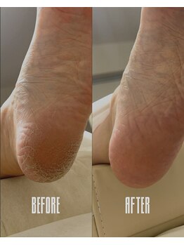 おん/ガサガサ踵