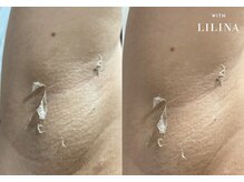 ウィズリリナ 新横浜(with Lilina.)/ローマピンク 症例　途中経過